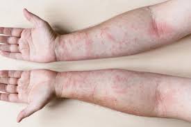 Earthing mise à la terre et eczéma: comment apaiser les démangeaisons ?