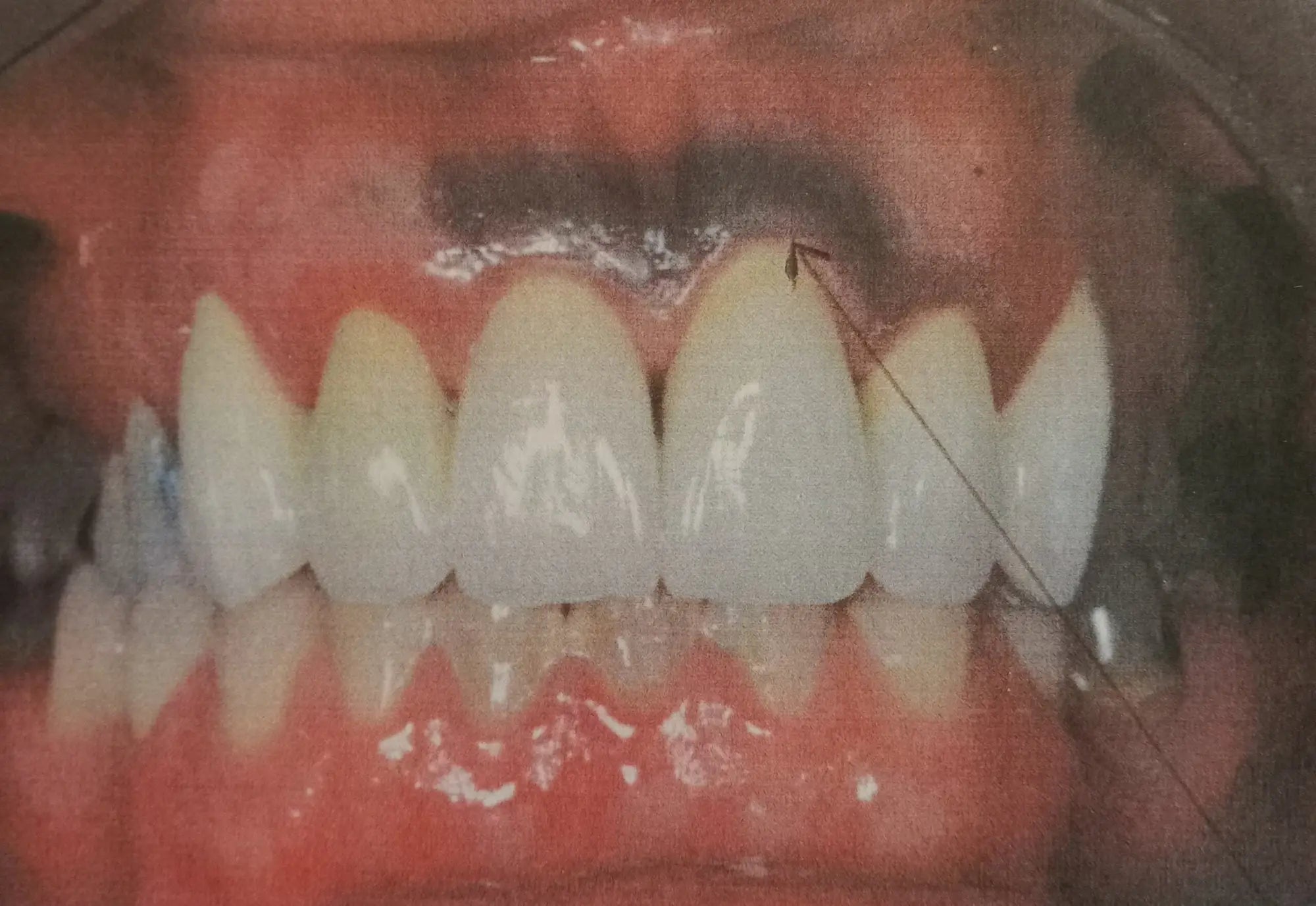 Dr valérie voisin: métaux en bouche champs électromagnétiques et santé:
