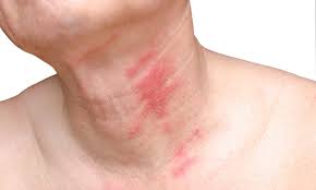 Terre Forme Rash Earthing mise à la terre et psoriasis: comment soulager les ...